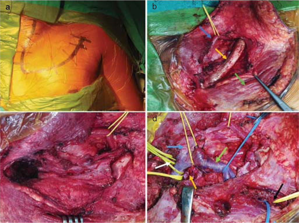 Intraoperative images. Incision (a). Skin flap has been retracted upwards and exposed structures are shown, inferior belly of omohyoid muscle (blue arrow), clavicle (yellow arrow) and pectoralis major muscle (green arrow) (b). Clavicle at the junction of middle and lateral one-third along with sternoclavicular joint has been removed (c). Following tumour decompression, internal jugular vein (blue arrow), subclavian vein (green arrow), tumour cavity (yellow arrow), proximal (white arrow) and distal controls (black arrow) on subclavian artery (d)