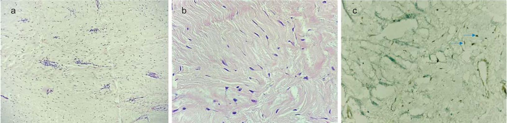 Haematoxylin and eosin-stained sections from tumour (a ×100; b ×400) show a hypocellular spindle cell neoplasm composed of bland spindle cells in a fibrotic stroma with interspersed thin wall vessels showing perivascular lymphocytic cuffing. The tumour cells (blue arrows) show nuclear accumulation of beta-catenin on immunohistochemistry (c ×400)