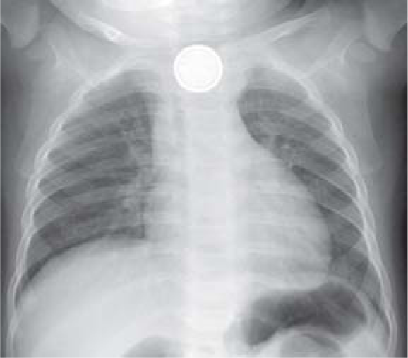 Chest X-ray showing a double ring sign in the oesophagus