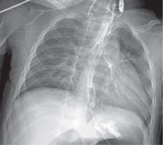 Upper gastrointestinal contrast imaging indicated an opening between the oesophagus and the trachea