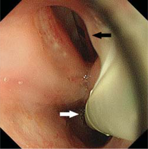 Upper gastrointestinal endoscopy showed a tracheooesophageal fistula. The intubation tube (black arrow) and the feeding tube (white arrow) were visible through the fistula