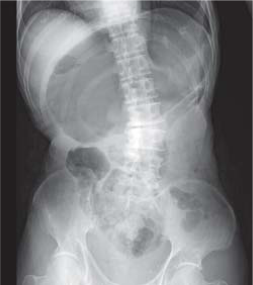 Abdominal X-ray showing massive gastric dilatation