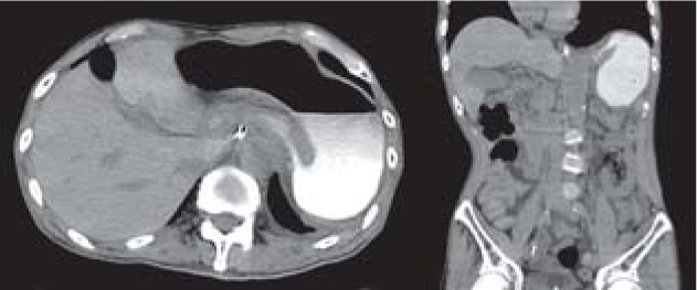 Computed tomography after administration of Gastrografin® revealing displacement of the antrum above the gastro-oesophageal junction and progressive tapering of the stomach, known as the bird’s beak sign