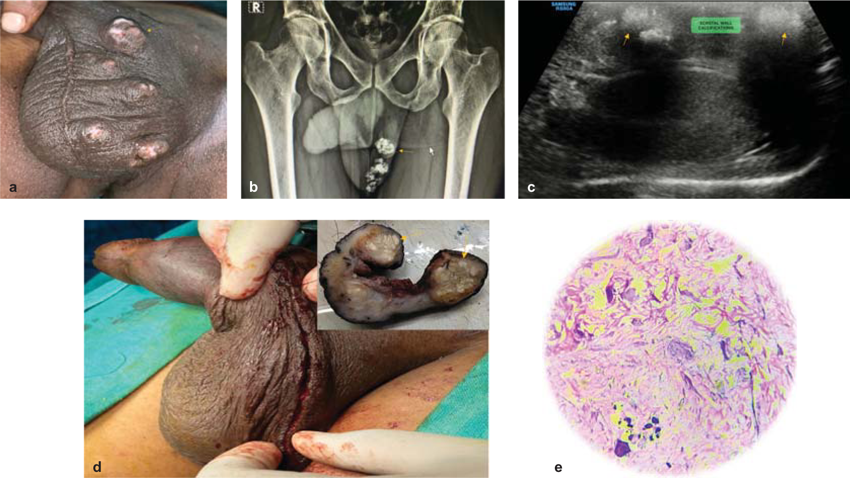 Multiple whitish nodular swellings are seen over the scrotum on the left side (a). An X-ray of the pelvis and scrotum showed multiple calcific foci in the left hemi-scrotum (b). High frequency ultrasound of the scrotum showed multiple roughly oval hyperechoic lesions with posterior acoustic shadowing in the subcutaneous plane of the scrotum representing calcifications, both testes were normal (c). The postoperative photograph (d) after left hemiscrotectomy. Histopathological slide of the deeper dermis showed calcific foci separated by bands of collagenous tissue. The intervening fibrocollagenous connective tissue had lymphocytic inflammatory infiltrates (e)