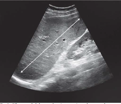 Ultrasound abdomen showing massive splenomegaly