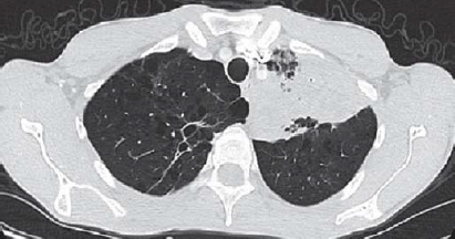 Computed tomography of the chest showing left upper lobe consolidation