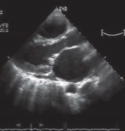 Vegetations on the tip of the anterior and posterior mitral valve leaflets in the parasternal long axis view