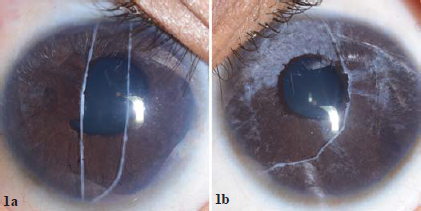 Slit-lamp photograph with diffuse illumination showing megalocornea, a white, cord-like structure resting on the anterior surface of the iris representing detached Schwalbe line with attached iris strands, iris atrophy and ectropion uveae.