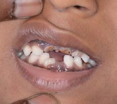 Clinical photograph showing enamel hypoplasia.