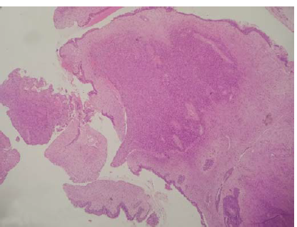 Polypoidal lesion displaying a well-defined distinct cellular neoplasm arranged in sheets (40× view, H&E).