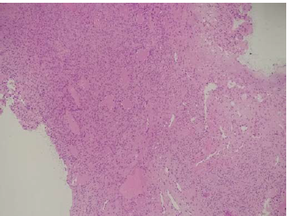 Spindle cell tumour with prominent slit-like and branching vascular spaces (100×, H&E).