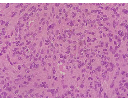 Tumour cells show moderate eosinophilic cytoplasm, plump oval nuclei and inconspicuous nucleoli (400×, H&E).