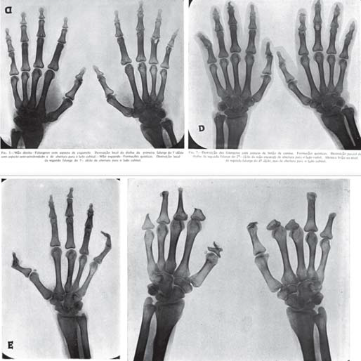 X-ray images showing progressive damage to the fingers over time by leprosy