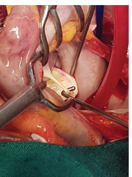 Operative view of the chorda attached to the anterior mitral valve leaflet and the left atrial wall