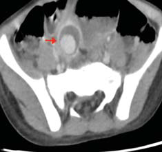 Contrast enhanced CT scan showed an aneurysm within the bowel lumen (arrow).