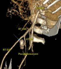 CT angiography shows an aneurysm (arrow) directed anteriorly and arising from the anterior branch of the internal iliac artery