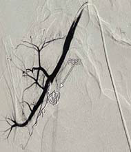 Post-endovascular coiling shows complete occlusion of the aneurysm