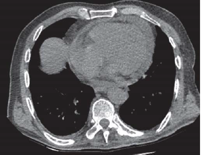 Pericardial fluid seen on lung tomography