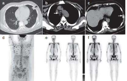 Chest computed tomography (CT) (a) revealed patchy shadows in the left lower lung; (b) mediastinal window revealed mediastinal lymphadenopathy; (c) mediastinal window revealed multiple areas of bone destruction; (d) Positron emission tomography (PET)/CT revealed multiple areas of superficial and deep lymph node enlargement, diffuse bone destruction; (e) radionuclide bone scan revealed multiple areas of superficial and deep lymph node enlargement, diffuse bone destruction.