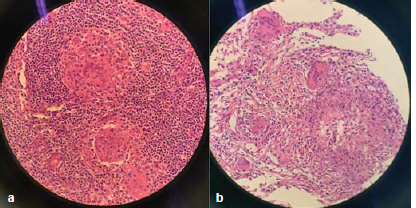(a) The right axillary lymph node biopsy revealed granulomatous inflammation and (b) the percutaneous pulmonary biopsy revealed granulomatous inflammation with necrosis, and multinucleated giant cell reaction.