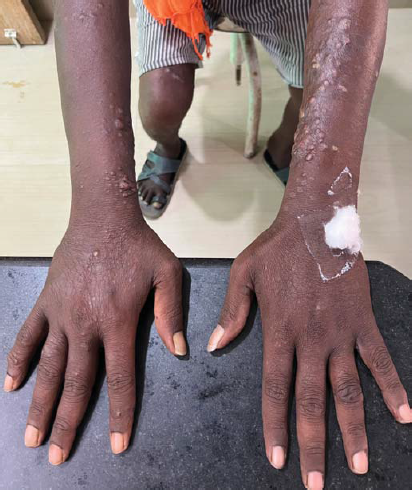 Histoid leprosy showing multiple, bilaterally symmetrical, non-tender, skin-coloured, shiny, dome-shaped, papulonodules over both arms
