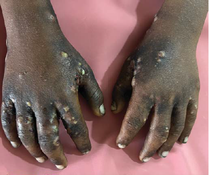 Extensive scabies with secondary infection showing pustules, erosions and excoriations in both hands