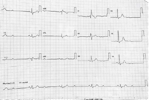 Electrocardiogram suggestive of severe bradycardia with complete right bundle branch block and 2:1 Mobitz type 2 block